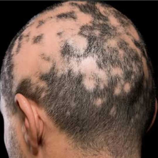 Alopecia