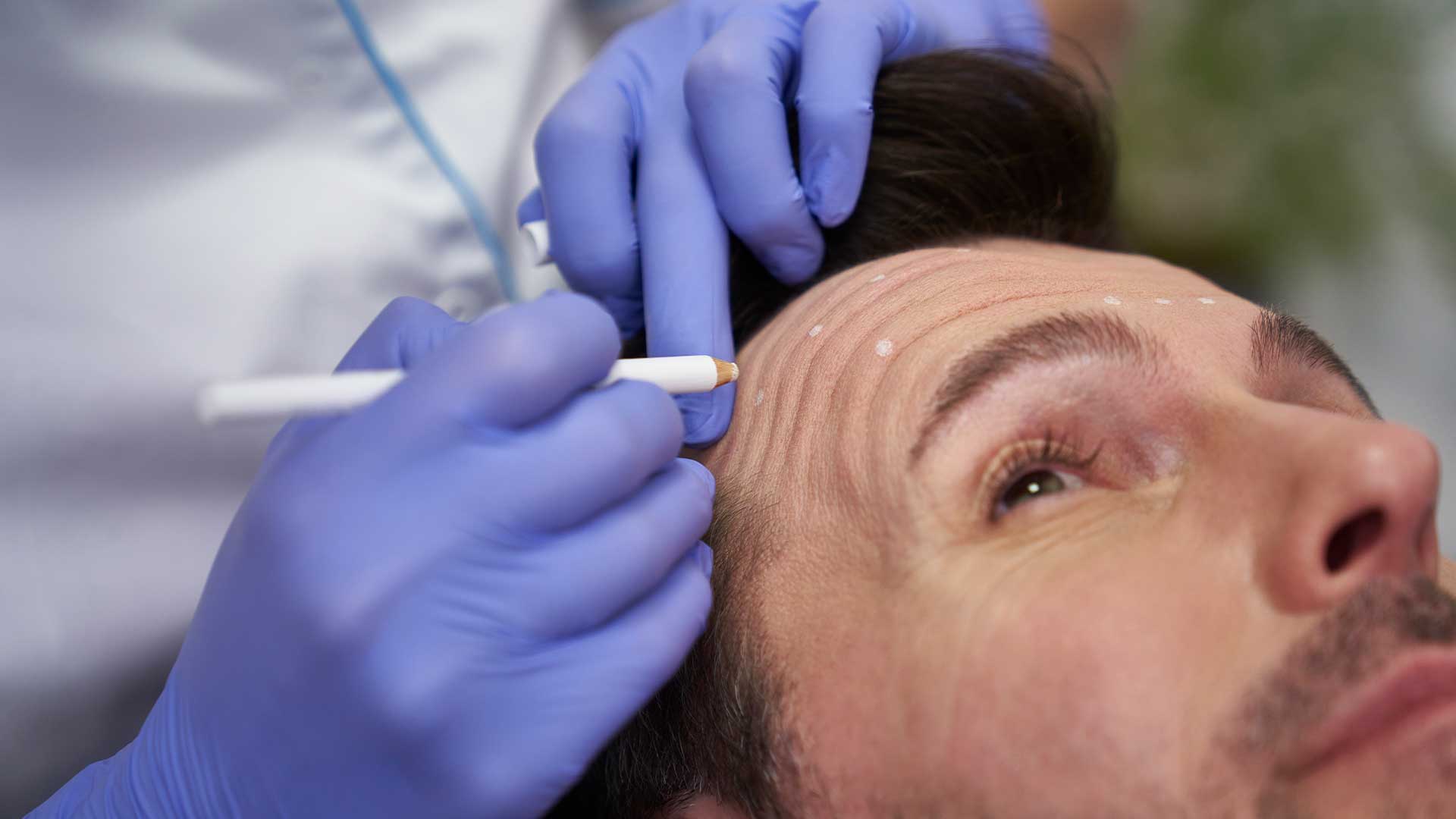 Applying Aesthetic Marker On Man