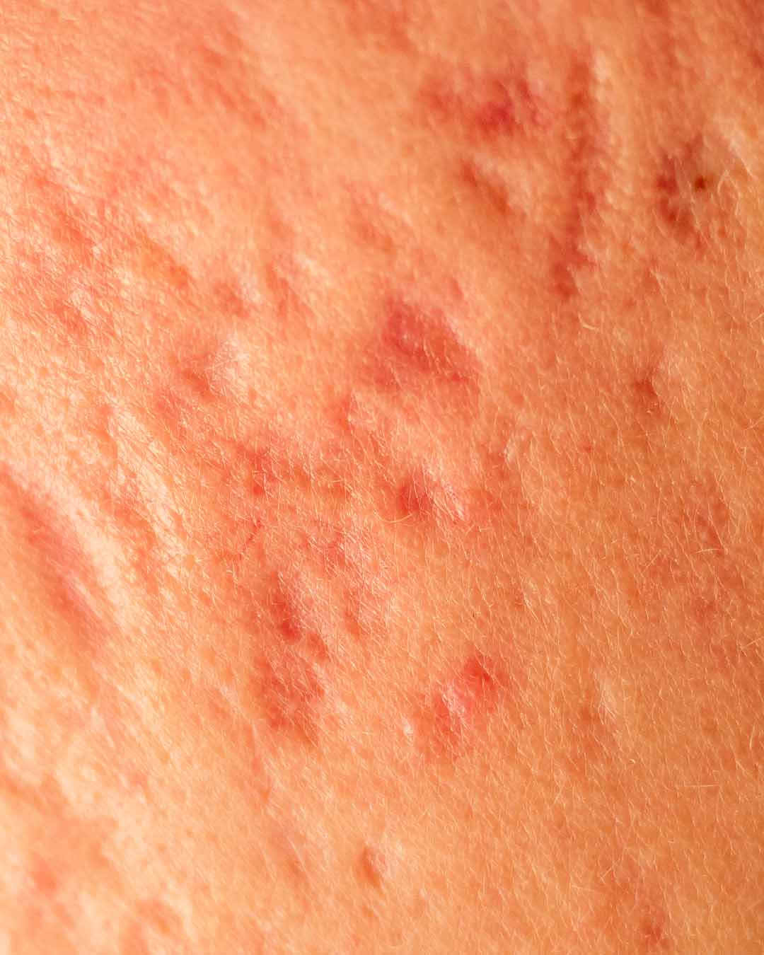 Closeup Of Acne Scars