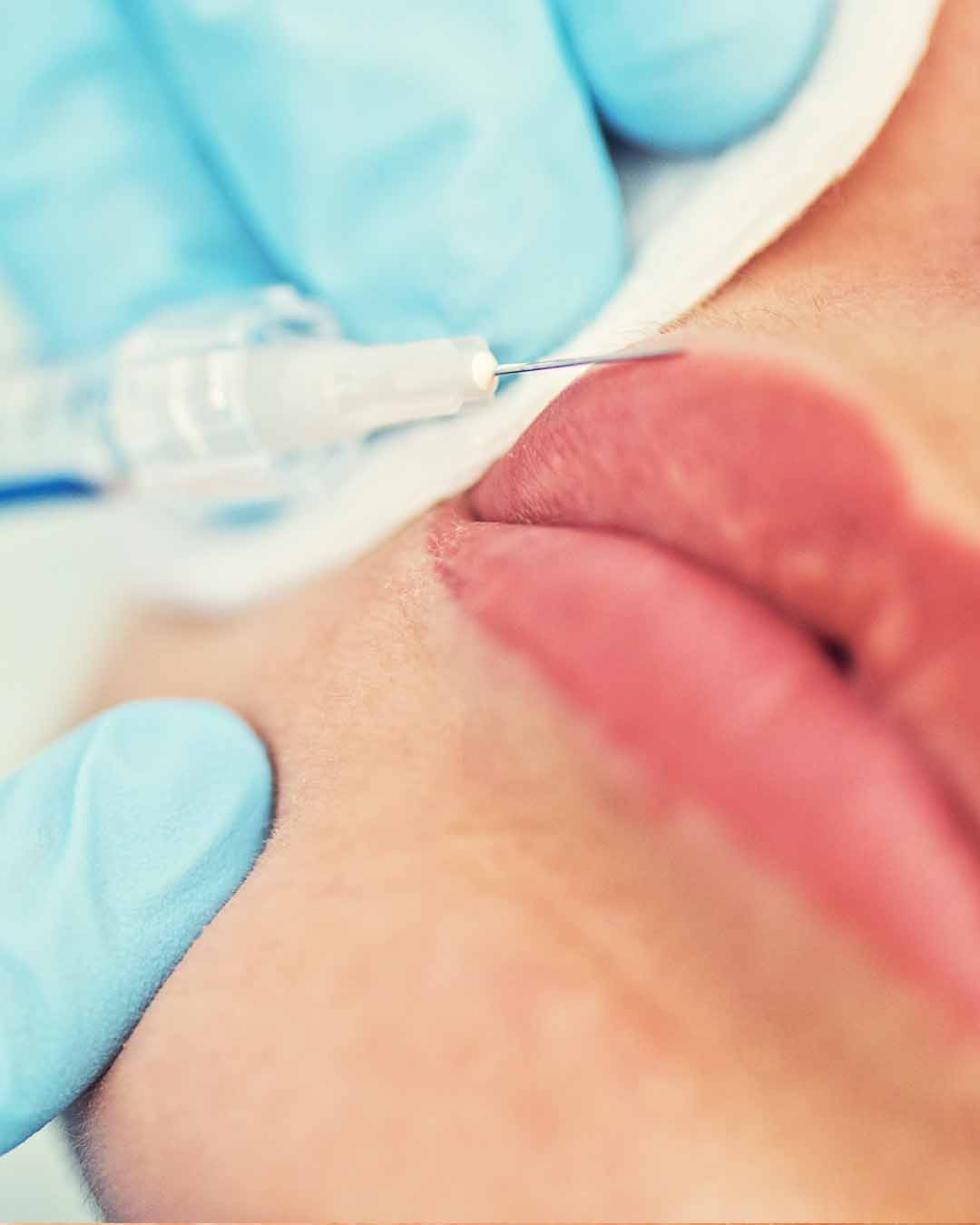 Closeup Of Lip Filler