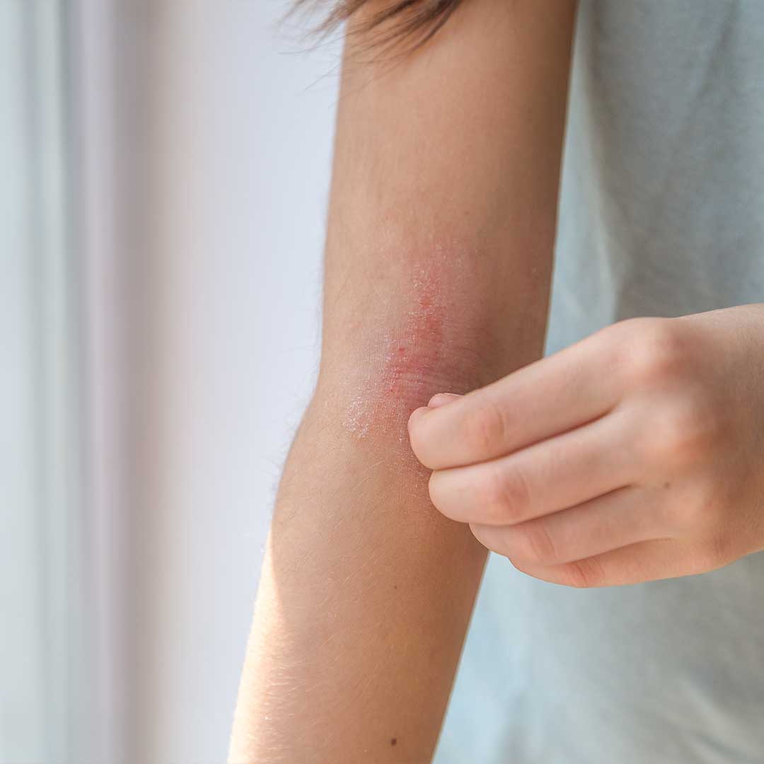 Eczema In Cubital Fossa