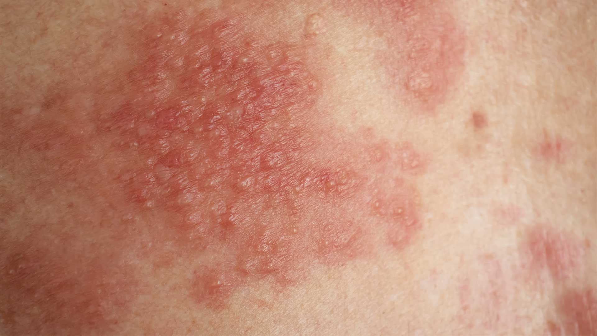 Eczema & Chronic Rashes | Central Alberta Dermatology Clinic