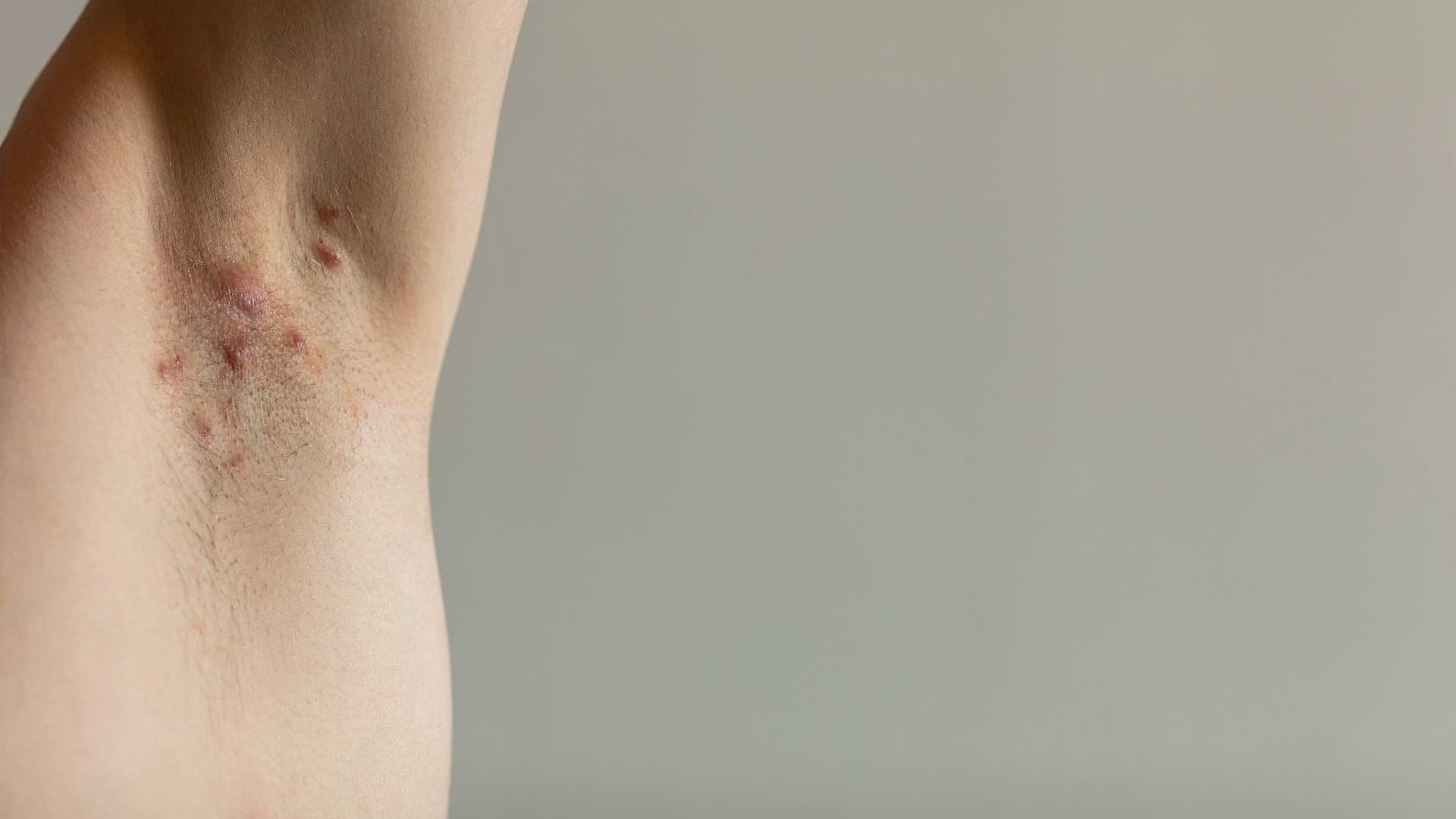 Hidradenitis Suppurativa Armpit