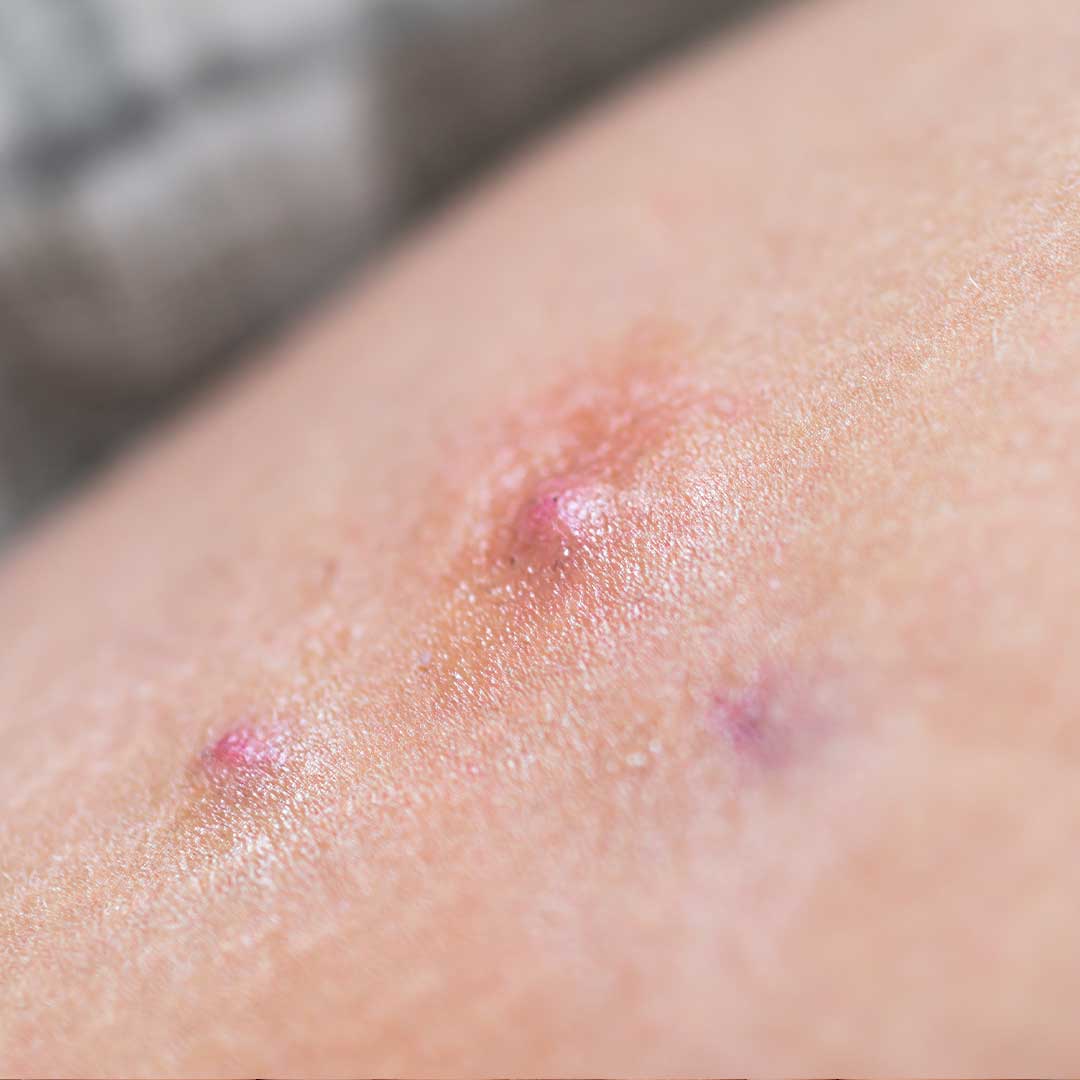 Hidradenitis Suppurativa Closeup