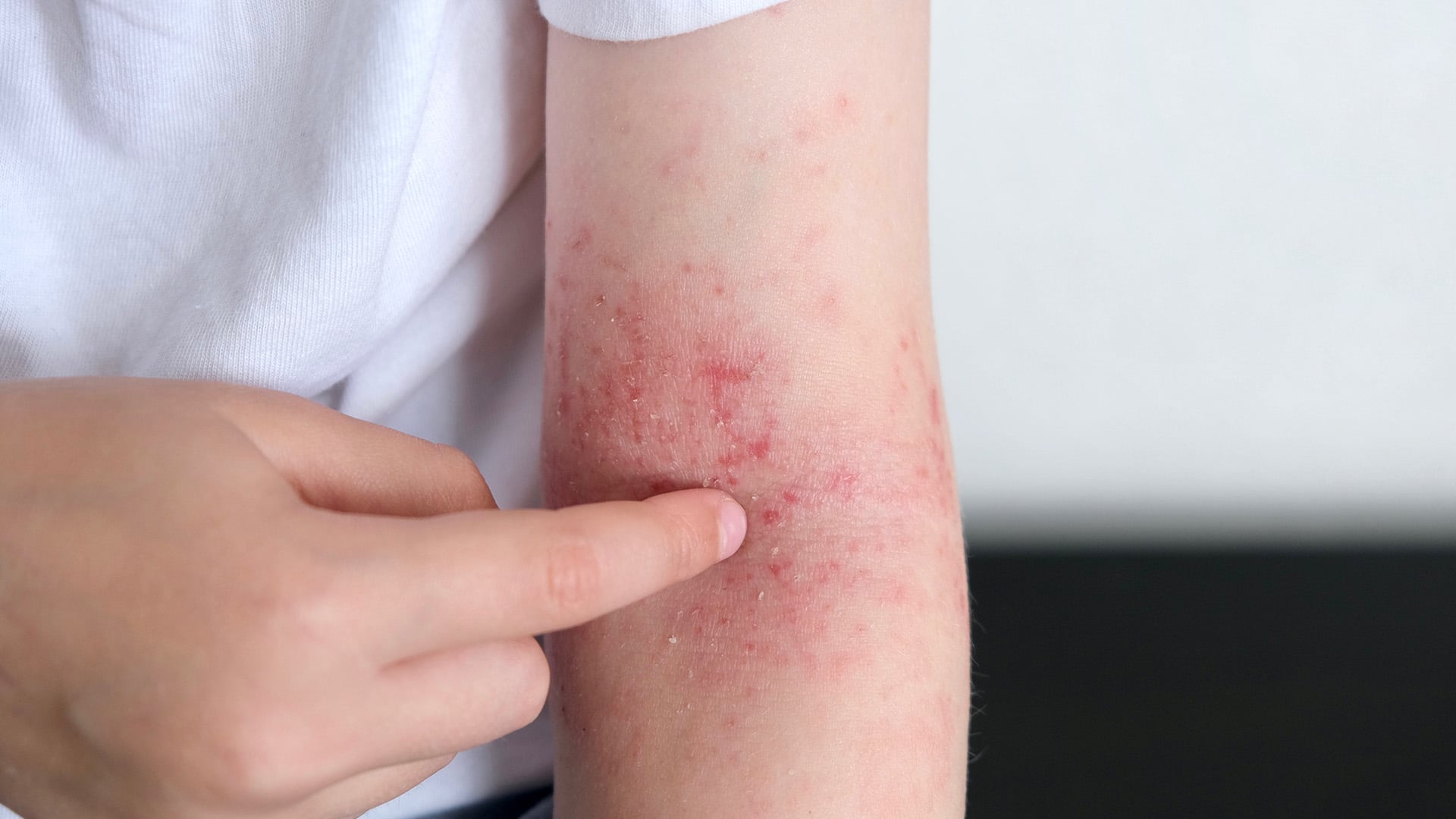 Kid With Contact Dermatitis