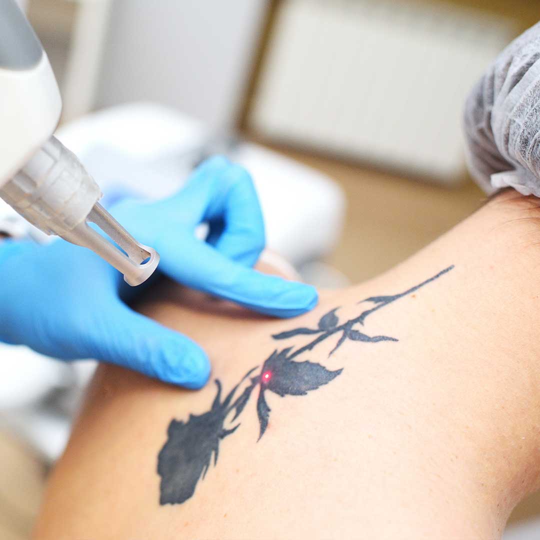 Laser Tattoo Removal