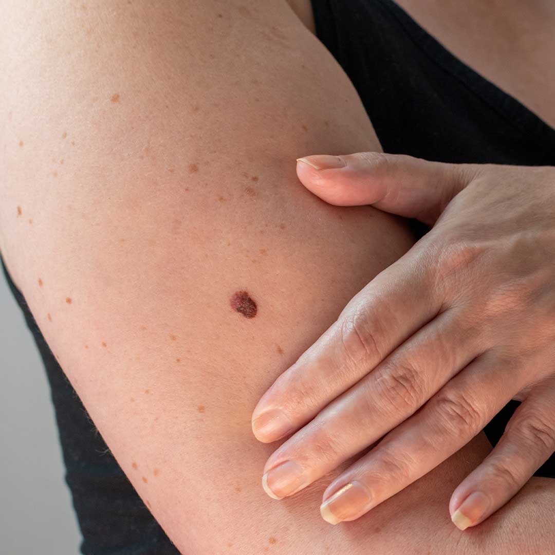 Possible Skin Cancer