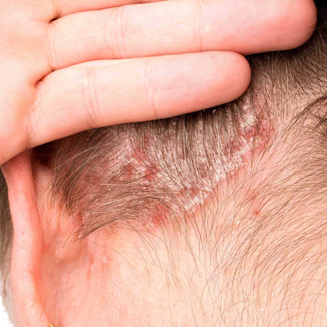Psoriasis On Scalp