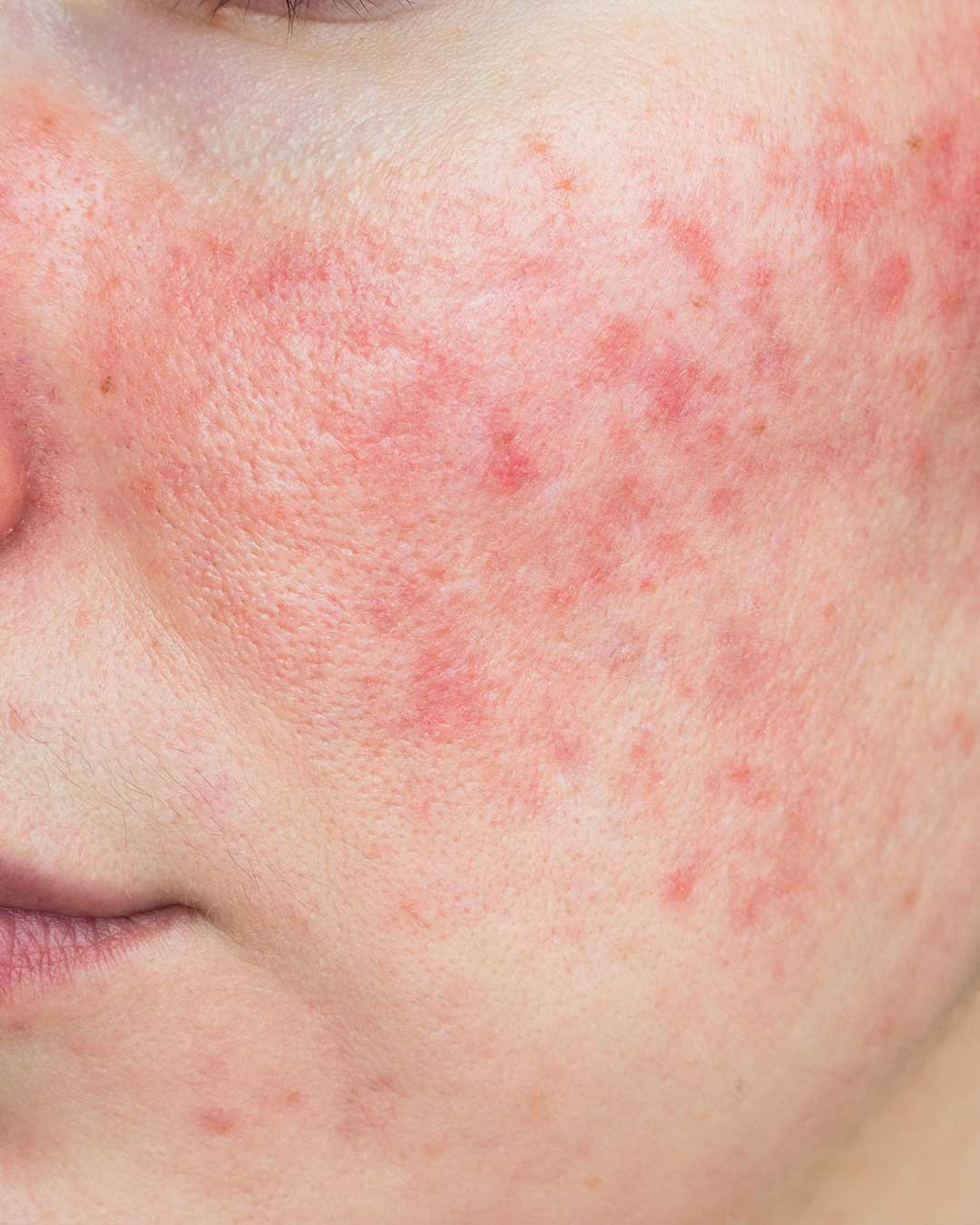 Rosacea On Cheeks