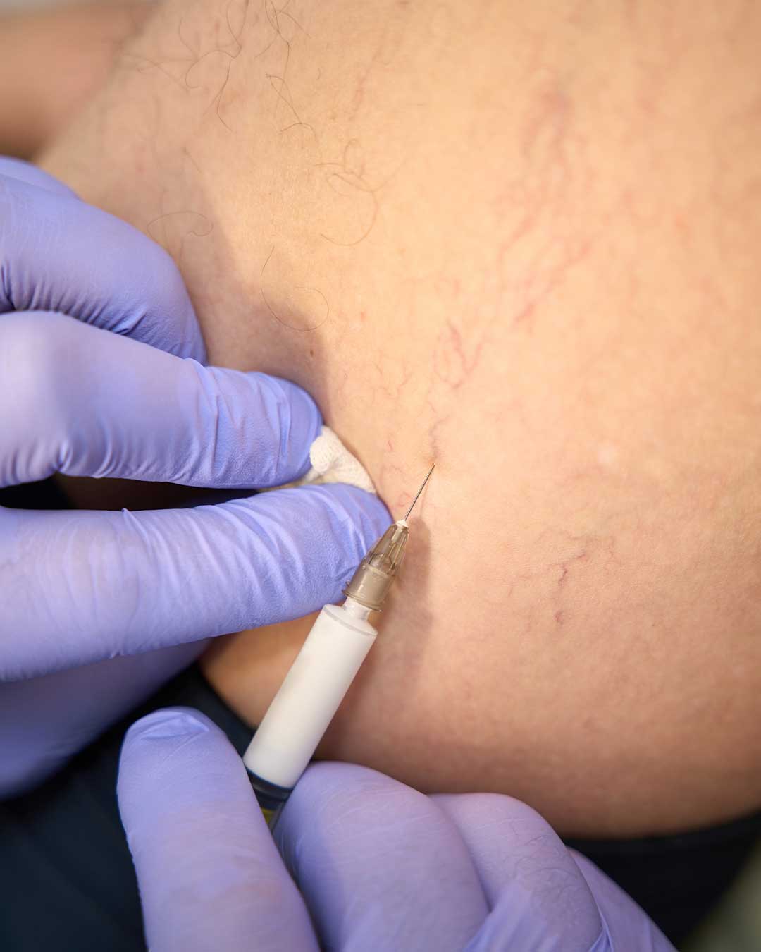 Sclerotherapy