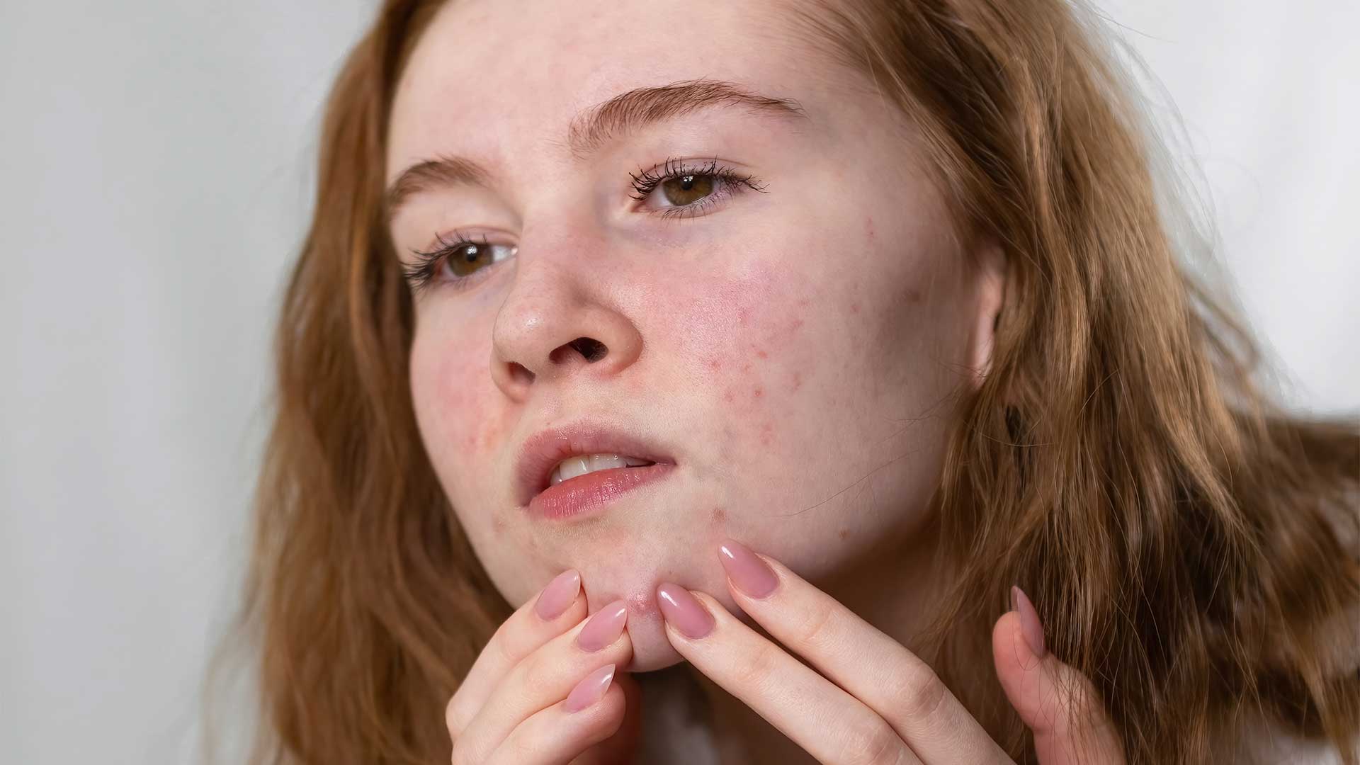 Teenager With Acne
