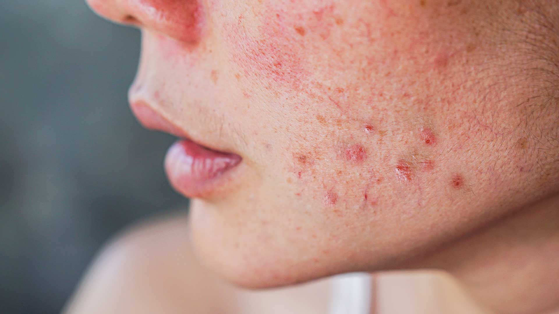 Woman With Acne2