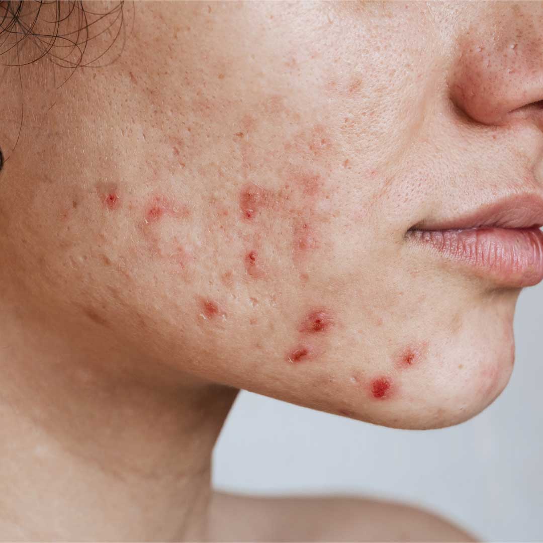 Woman With Acne